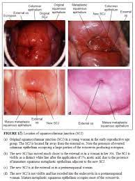 Squamous metaplasia is a medical term used to describe the changes occurring to the cells in certain tissues of the body. Colposcopy And Treatment Of Cervical Intraepithelial Neoplasia A Beginners Manual