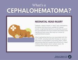 Image result for Vacuum Caput