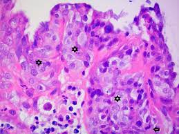 Uber diffuse myokarditis, virchows arch pathol anat , 1905, vol. Traumatische Myokarditis Einer Katze