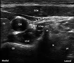 Ultrasound Guided Percutaneous Cervical And Upper Thoracic Sympathetic Chain Neuromodulation For Upper Extremity Complex Regional Pain Syndrome Ochsner Journal