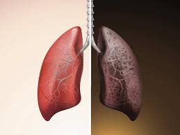 Even for someone who has never smoked, being exposed to secondhand smoke—which includes both the smoke that's emitted from the end of a burning cigarette and the smoke that's exhaled by the person smoking the cigarette. Lung Cancer Non Smokers Can Get Lung Cancer And The Reasons Are Around Us The Economic Times