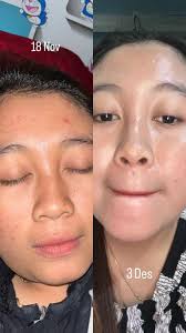 cari skincare harga terjangkau? Dan ada hasil ? Fix sih kalian wajib cobain  BGSKIN 💃 Sudah BPOM DAN TER UJI LAB konsultasi gratis!!!! 082124467320