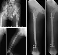 8 Rigid trochanteric entry intramedullary femoral nail in an ...