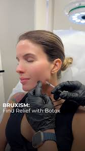 🧬 Botulinum toxin injections, also known as Botox, can help with bruxism,  teeth grinding and TMJ by reducing the frequency and severity of grinding  episodes., It helps to reduce the severity of ...