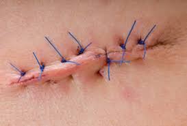 If its too severe,please meet your doctor so that the area can be examined for any irritant dermatitis and proper. The Difference Between Healing And Infected Surgical Wounds