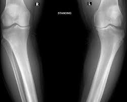 Image result for Genu Varum