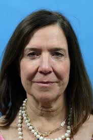 Facelift Before and After 03