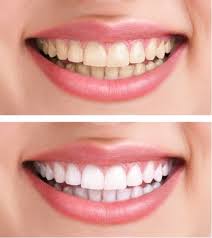 Cosmetic dentistry near me in fresno, ca. Have A Brighter Smile With Cosmetic Dentistry Killiney Dental
