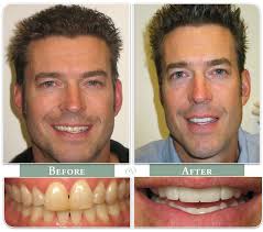 Anthony mobasser explains veneers vs lumineers to help you determine which is best for you! Porcelain Veneers Gallery Glassman Dental Care Uws Nyc