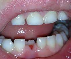 Dental Questions Are My Child S Front Teeth Coming In Normally