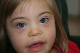 Although, this is normal in people of asciatic descent, children with inherited genetic disorders also have it. Big Blueberry Eyes Characteristics