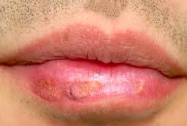 Image result for Oncinotis