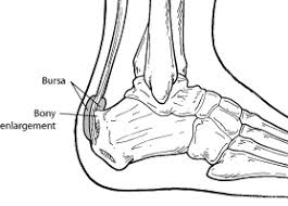 Related online courses on physioplus. Haglund S Deformity Acfas