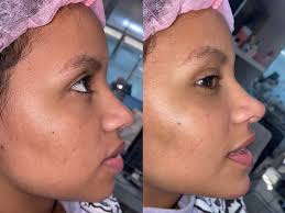 A participante do reality show no limite, paula amorim, surpreendeu todos os seus seguidores ao mostrar no seu perfil do instagram um antes e depois do seu corpo, um mês depois da gravação do programa. Gleici Damasceno Faz Harmonizacao Facial Veja Antes E Depois
