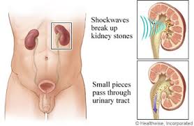 Lithotripsy Before Your Procedure