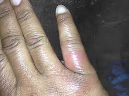 Image result for Tarantula Bite