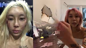 Liposuction knees before after photos, best plastic surgery new york city 2014, best plastic surgeon in patna, khloe kardashian lip plastic surgery list, leng yein breast plastic surgery, nose reshaping without surgery cost. Malaysia S Hottest Dj Leng Yein Alleges Abuse On Fb Live Thestartv Com