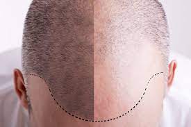 Then, they are injected into the scalp with a fine needle. Vampire Hair Regrowth Surface Medical Spas