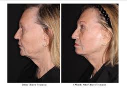 How Can I “Lift” My Neck Without Surgery? Dignity Medical Aesthetics &  Wellness