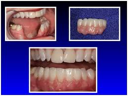 Image result for dental cancer