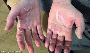 Jun 19, 2014 · in this situation, however, the patient's risk of dying from organ dysfunction, sepsis, or severe sepsis is very low. Bristol Dad Nearly Died After Infection Triggered Sepsis Express Digest