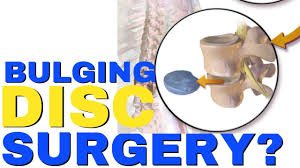 Does A Bulging Disc Require Surgery L4 L5 Disc Bulge Surgery Chiropractor In Vaughan Youtube
