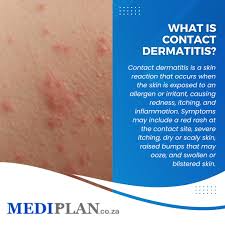 Image result for Contact Dermatitis