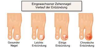 Eingewachsener Zehennagel Unguis Incarnatus Alles Was Du Wissen Musst