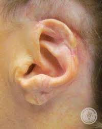 Ear Surgery Dr J J Wendel Plastic Surgery Nashville