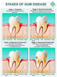Several gingivitis treatments, at home or at your dentist, can effectively reverse this condition before it leads to jawbone loss or more serious problems. Gum Disease Why It S So Serious And 4 Natural Remedies To Help Treat It Gum Disease Treatment Swollen Gums Remedy Gingivitis Treatment