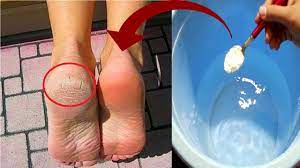 How To Get Rid Of Cracked Heels