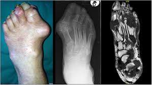 Image result for gout
