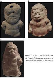 Mucopolysaccharidosis Type Vi Maroteaux Lamy Syndrome In The Pre Columbian Culture Of Colombia