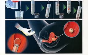 Các phương pháp điều trị vô sinh được áp dụng nhiều hiện nay