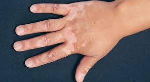 Now dah kembali pulih (7 bulan berubat) mahal sikit tapi berkualiti. Klinik Nik Azam Vitiligo Ialah Penyakit Kulit Di Mana Facebook