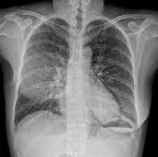 Treatment may fail if the catheter is not placed optimally within the loculation or if the fluid is hemorrhagic or fibrinous. Pleural Effusion Amboss