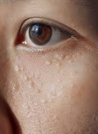 Image result for milium cyst on eyelid