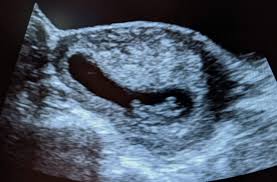 Unfortunately, it's hard to get a medical ultrasound for much less than that. What Is A Nuchal Translucency Ultrasound And How Much Should It Cost Max Out Of Pocket