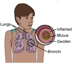 Image result for Acute Bronchitis