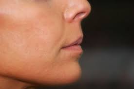 The Best Concealer For Broken Veins On Face Broken Veins Best Concealer Broken Capillaries