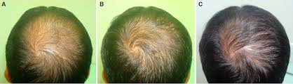 Although topical minoxidil is an effective treatment option for hair loss, many patients are poorly compliant because of the necessity to apply the medication twice a day, undesirable hair texture, and scalp irritation. Controlled Clinical Trial For Evaluation Of Hair Growth With Low Dose Cyclical Nutrition Therapy In Men And Women Without The Use Of Finasteride