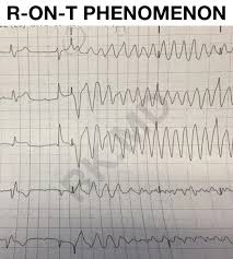 Image result for Extrasystole