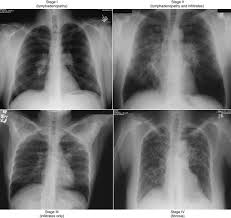 Emphysema involves gradual damage of lung tissue, specifically thinning and destruction of the alveoli or air sacs. The Stages Of Pulmonary Sarcoidosis What Do They Really Mean Foundation For Sarcoidosis Research