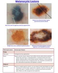 Image result for Blue Nevus