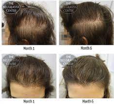 Hair Loss And Thyroid Disorder Click Image To Review More Details This Is An Amazon Affiliate Link Postpartum Hair Loss Thyroid Hair Hair Loss Treatment