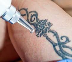 And you also need to follow a proper tattoo aftercare instructions. Laser Tattoo Removal Huntington Ny Is Laser Tattoo Removal Worth It