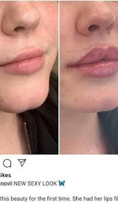 Maybe you would like to learn more about one of these? Results After 1ml Juvederm In Upper Lip Only Will 1 More Syringe Be Enough To Achieve The Aesthetic I Want Photo