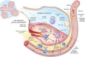 In the 1950s and '60s, the 'phage type 80/81 strain spread widely. Polymorphonuclear Leukocytes Mediate Staphylococcus Aureus Panton Valentine Leukocidin Induced Lung Inflammation And Injury Pnas