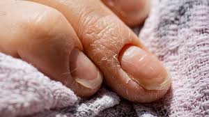 Image result for Nail Pitting