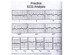 Kemampuan dalam melakukan interpretasi ekg disritmia diobgervasi sebelum dan seteinh pemberian media inovatif hasil penclitian menunjukkan sebelum inten'ensi adalah 22.43 poin dan setelah intenensi mcningkat tnenjadi poin. Elektrokardiogram Ppt Download